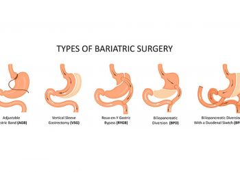 What Are the Reasons Behind Bariatric Surgery Revision?