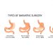 What Are the Reasons Behind Bariatric Surgery Revision?