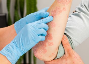 Nurturing Your Skin: Eczema Solutions from Nature