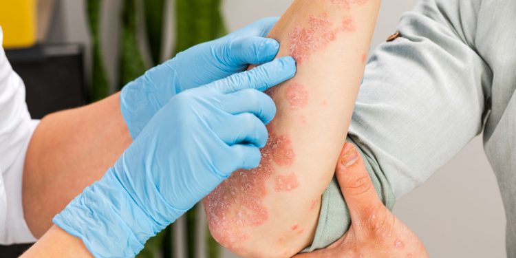 Nurturing Your Skin: Eczema Solutions from Nature