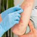 Nurturing Your Skin: Eczema Solutions from Nature